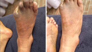 足の創傷をいかに治すか : 糖尿病フットケア・Limb salvageへのチー… Amazon.co.jp: 足の創傷をいかに治すか: 糖尿病フットケア・Limb