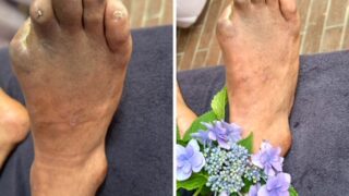 足の創傷をいかに治すか : 糖尿病フットケア・Limb salvageへのチー… Amazon.co.jp: 足の創傷をいかに治すか: 糖尿病フットケア・Limb